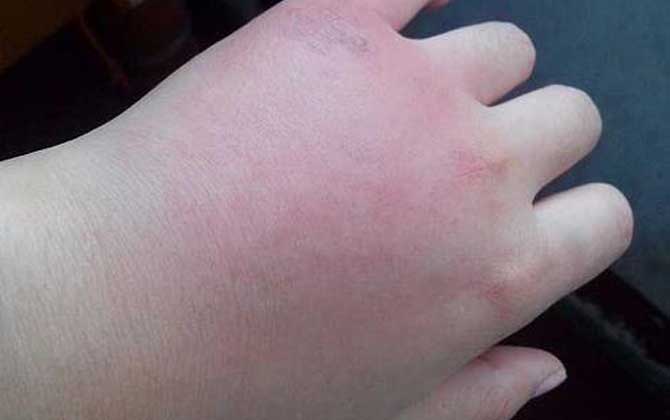 被虎頭蜂蟄了的人會怎樣?看圖片都疼,珍愛生命,遠離虎頭蜂! 被虎頭蜂蟄