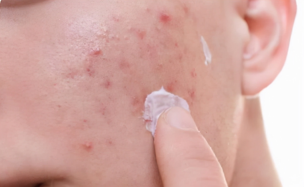 油性皮膚毛孔粗大怎么辦 面部皮膚油膩?學(xué)會這3個洗臉小技巧,讓你遠離“毛孔粗大”煩惱