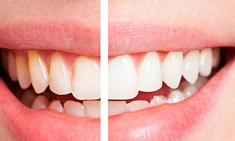 牙齒初老的信號(hào)有哪些 牙齒開(kāi)始“衰老”的三大癥狀,你可要當(dāng)心了